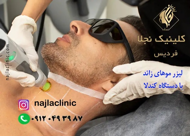 لیزر فردیس