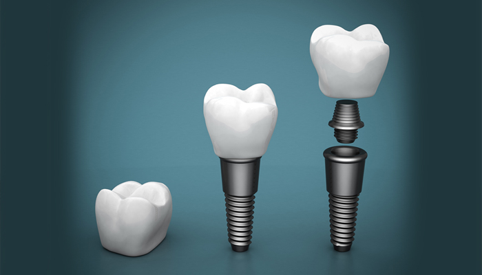 ایمپلنت دندان